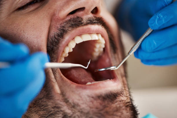 Best Emergency Wisdom Tooth Extraction in Surrey, ND
